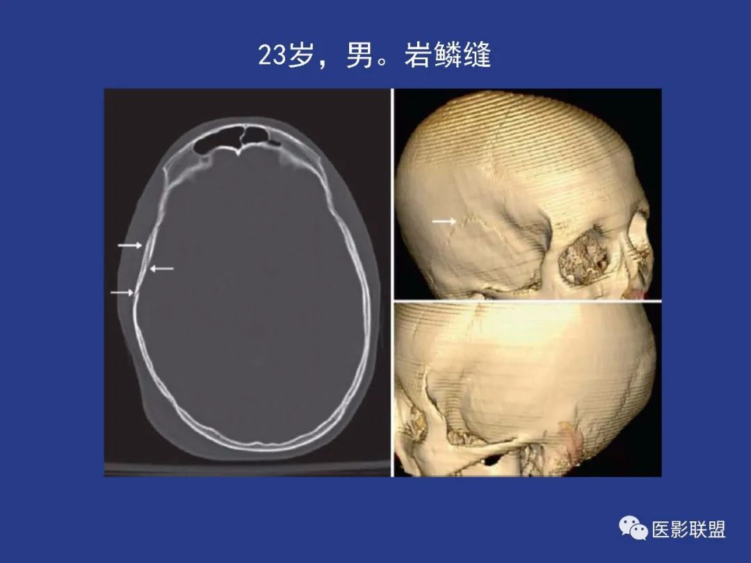 影像PPT - 【PPT】颅穹隆骨正常及常见变异的影像学表现-76