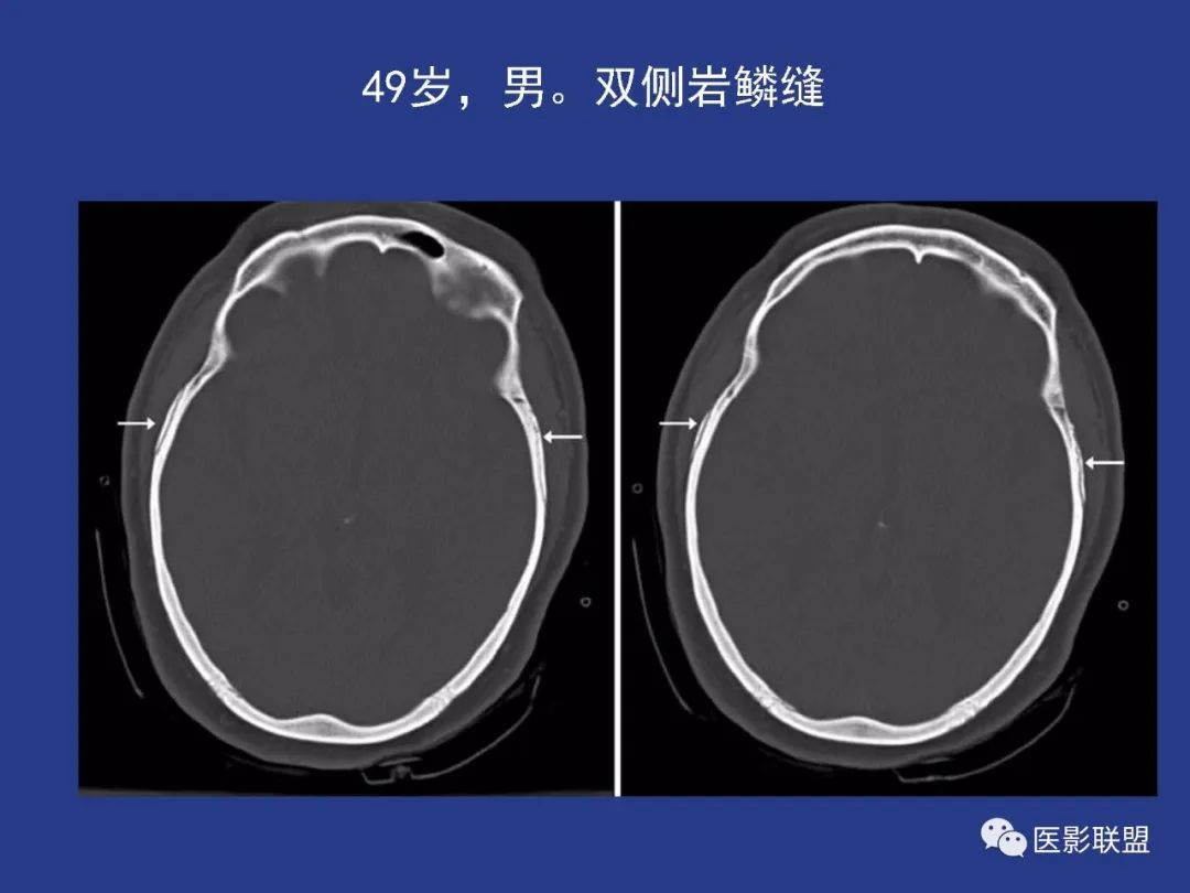影像PPT - 【PPT】颅穹隆骨正常及常见变异的影像学表现-77