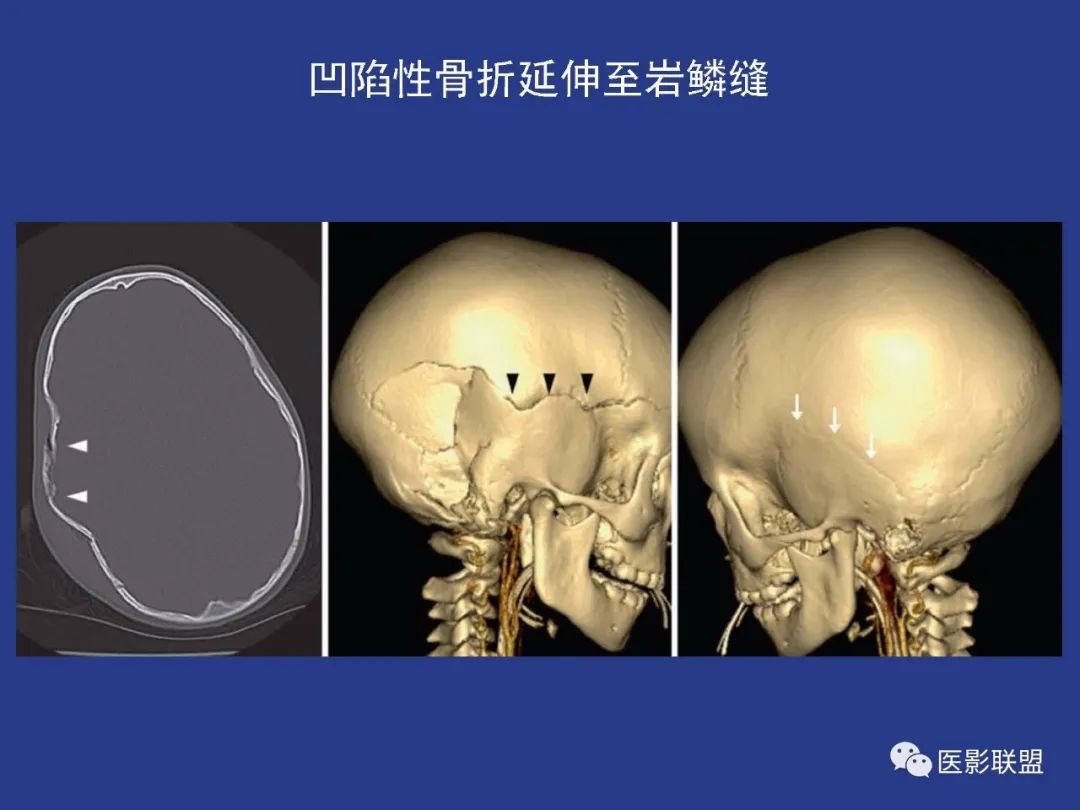 影像PPT - 【PPT】颅穹隆骨正常及常见变异的影像学表现-78