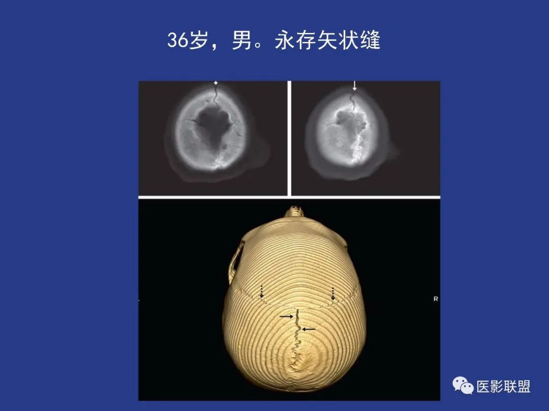 影像PPT - 【PPT】颅穹隆骨正常及常见变异的影像学表现-79