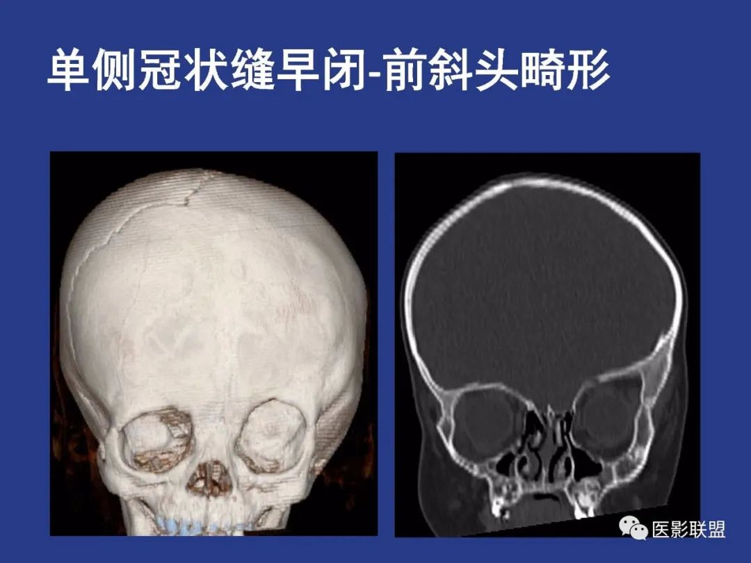 影像PPT - 【PPT】颅穹隆骨正常及常见变异的影像学表现-80