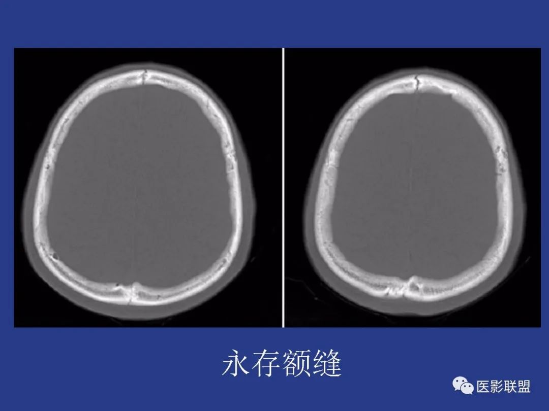 影像PPT - 【PPT】颅穹隆骨正常及常见变异的影像学表现-75