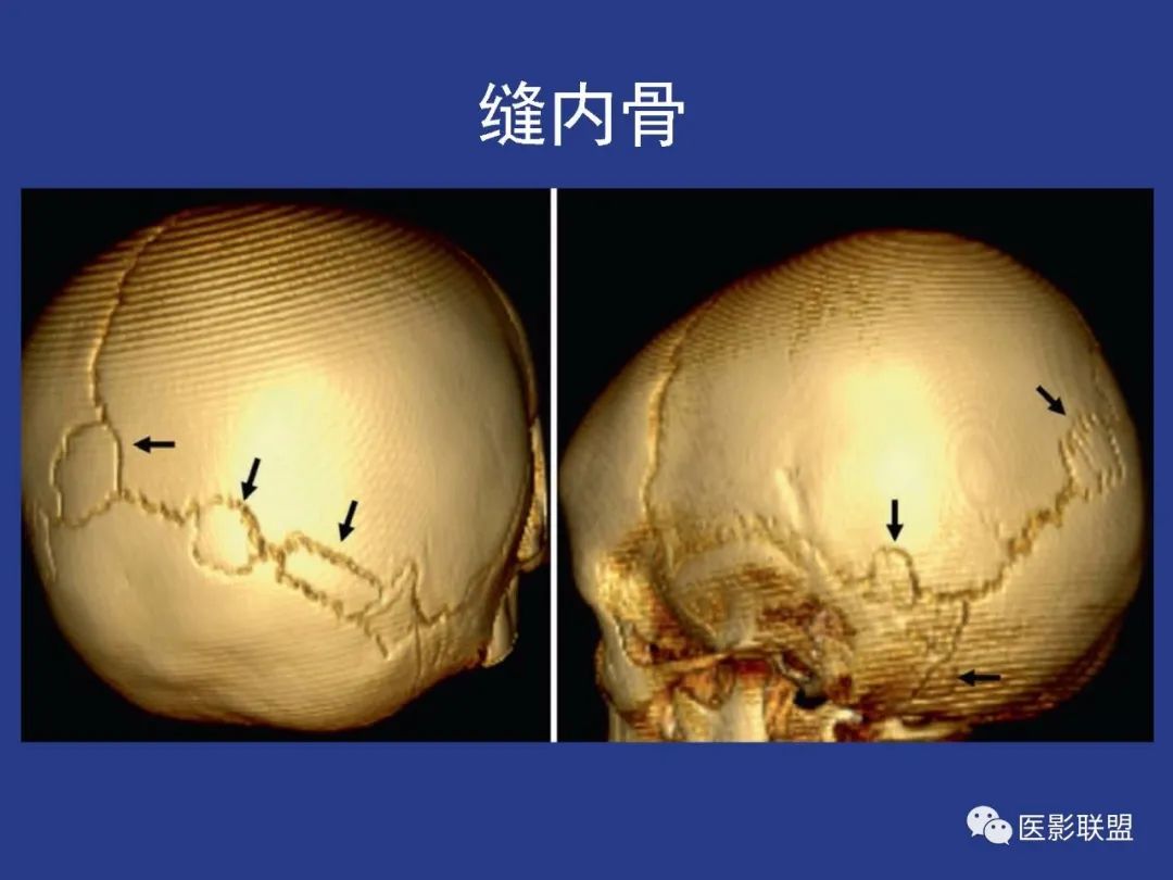 影像PPT - 【PPT】颅穹隆骨正常及常见变异的影像学表现-86