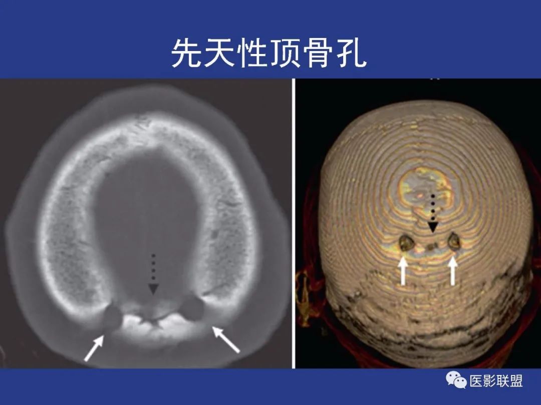 影像PPT - 【PPT】颅穹隆骨正常及常见变异的影像学表现-87