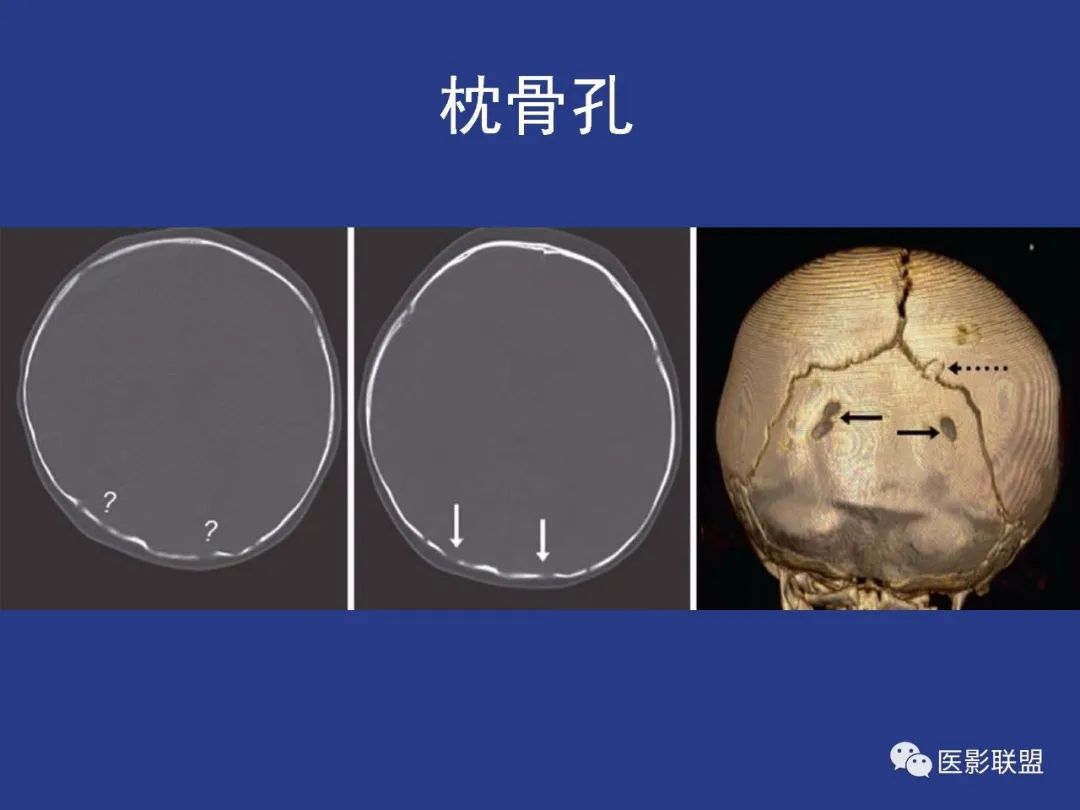 影像PPT - 【PPT】颅穹隆骨正常及常见变异的影像学表现-88