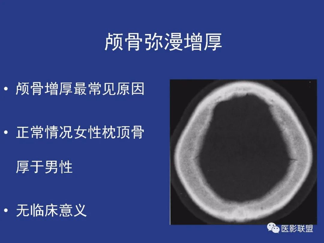 影像PPT - 【PPT】颅穹隆骨正常及常见变异的影像学表现-89