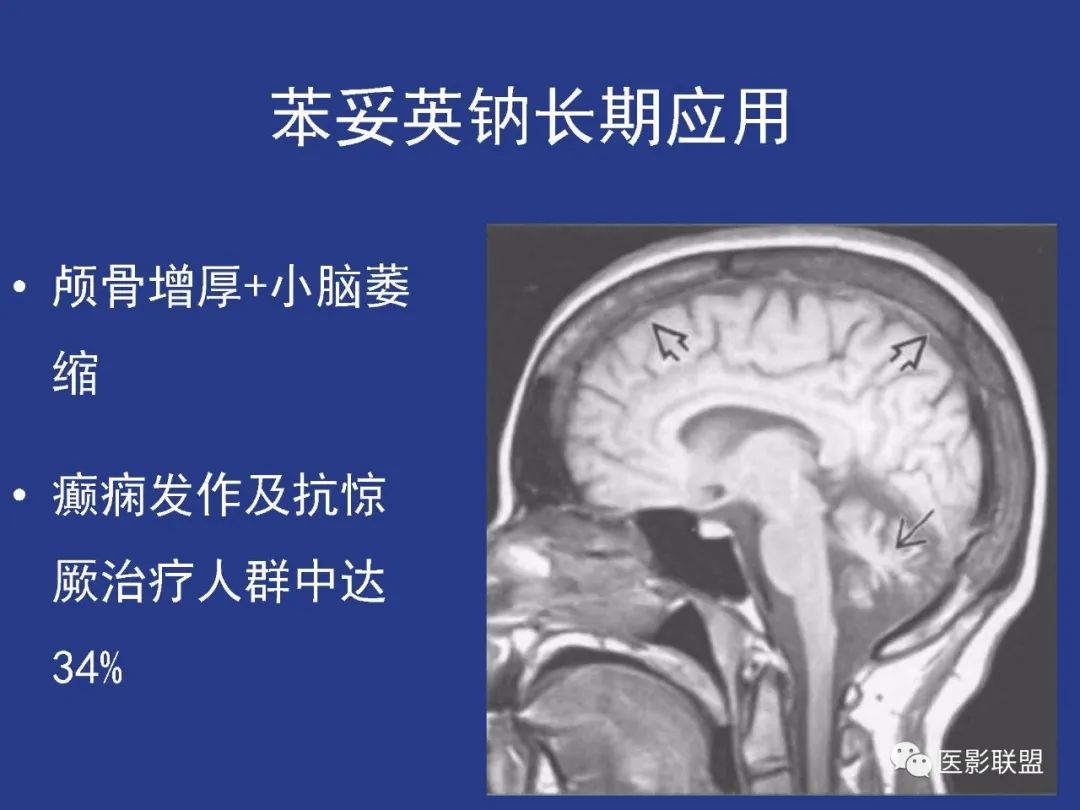 影像PPT - 【PPT】颅穹隆骨正常及常见变异的影像学表现-93