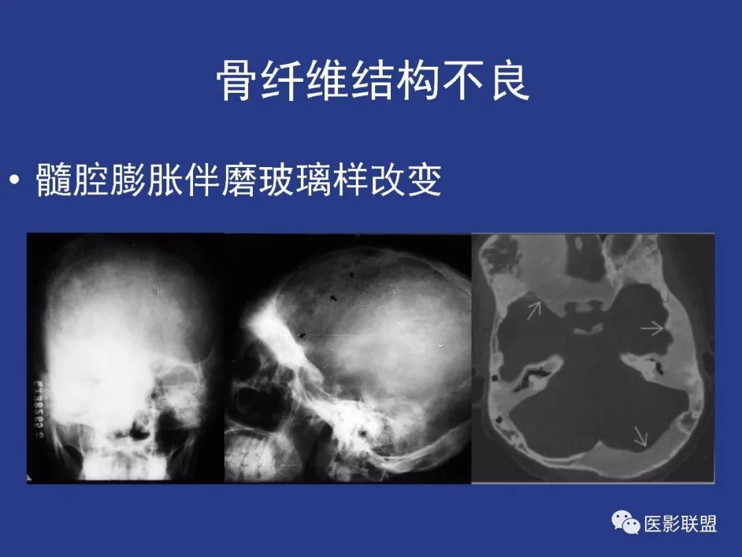 影像PPT - 【PPT】颅穹隆骨正常及常见变异的影像学表现-97
