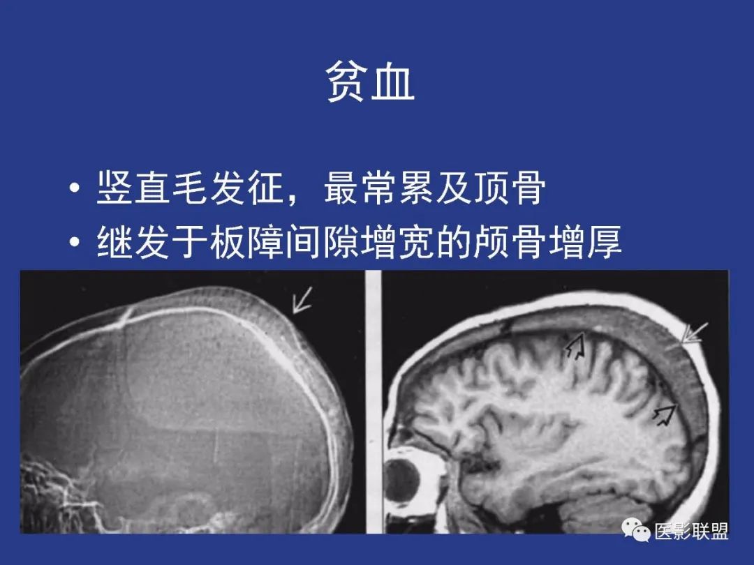 影像PPT - 【PPT】颅穹隆骨正常及常见变异的影像学表现-100