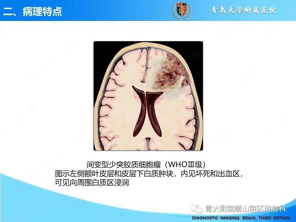 影像PPT - 【PPT】少突胶质细胞肿瘤的影像诊断与鉴别-9
