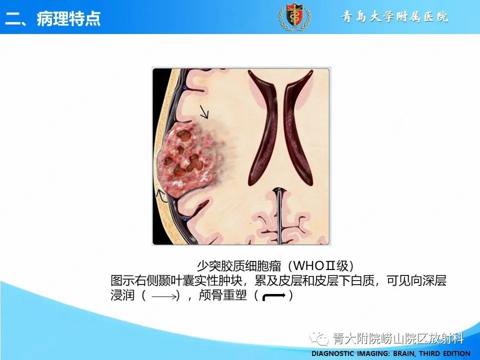 影像PPT - 【PPT】少突胶质细胞肿瘤的影像诊断与鉴别-8