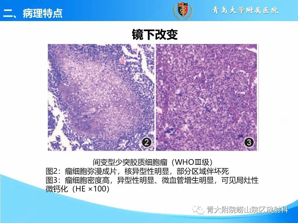 影像PPT - 【PPT】少突胶质细胞肿瘤的影像诊断与鉴别-11