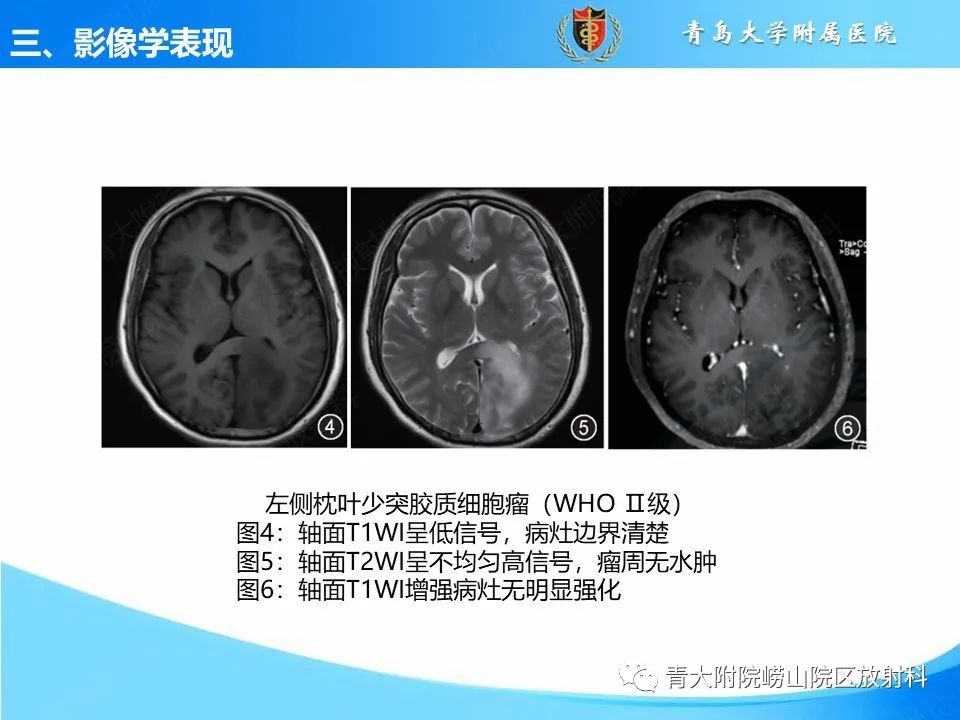 影像PPT - 【PPT】少突胶质细胞肿瘤的影像诊断与鉴别-13