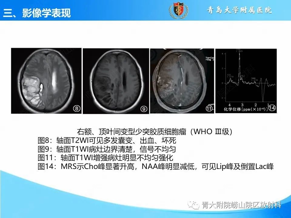 影像PPT - 【PPT】少突胶质细胞肿瘤的影像诊断与鉴别-16