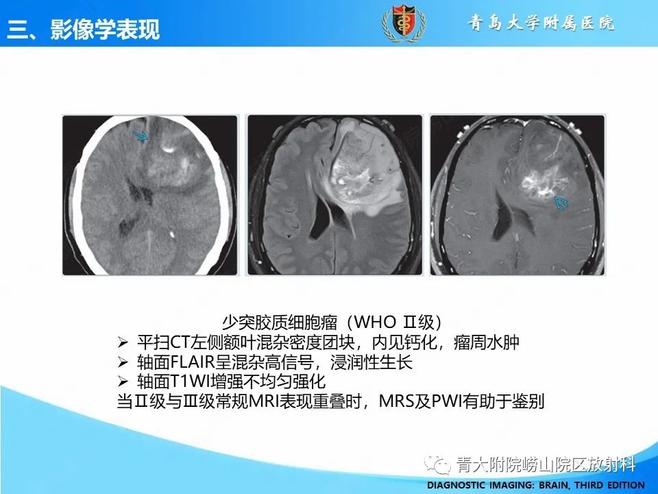 影像PPT - 【PPT】少突胶质细胞肿瘤的影像诊断与鉴别-14