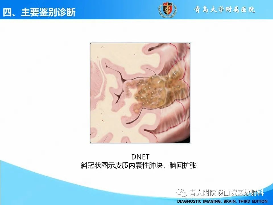 影像PPT - 【PPT】少突胶质细胞肿瘤的影像诊断与鉴别-18