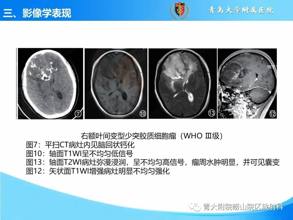 影像PPT - 【PPT】少突胶质细胞肿瘤的影像诊断与鉴别-15