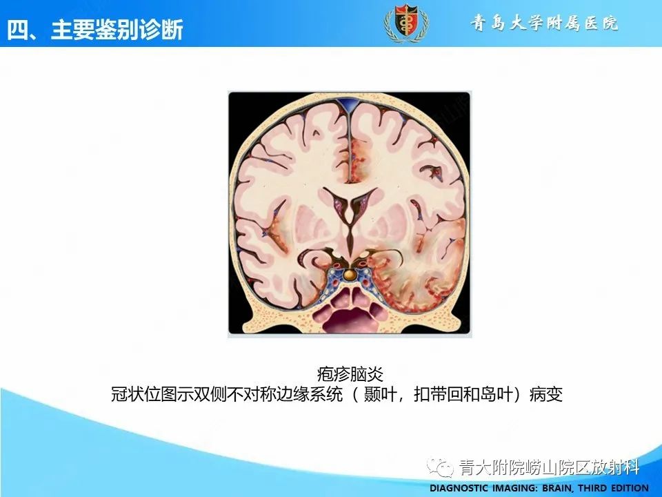 影像PPT - 【PPT】少突胶质细胞肿瘤的影像诊断与鉴别-23