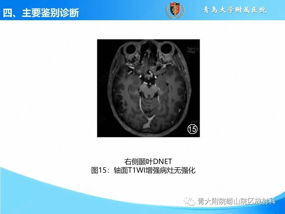 影像PPT - 【PPT】少突胶质细胞肿瘤的影像诊断与鉴别-21