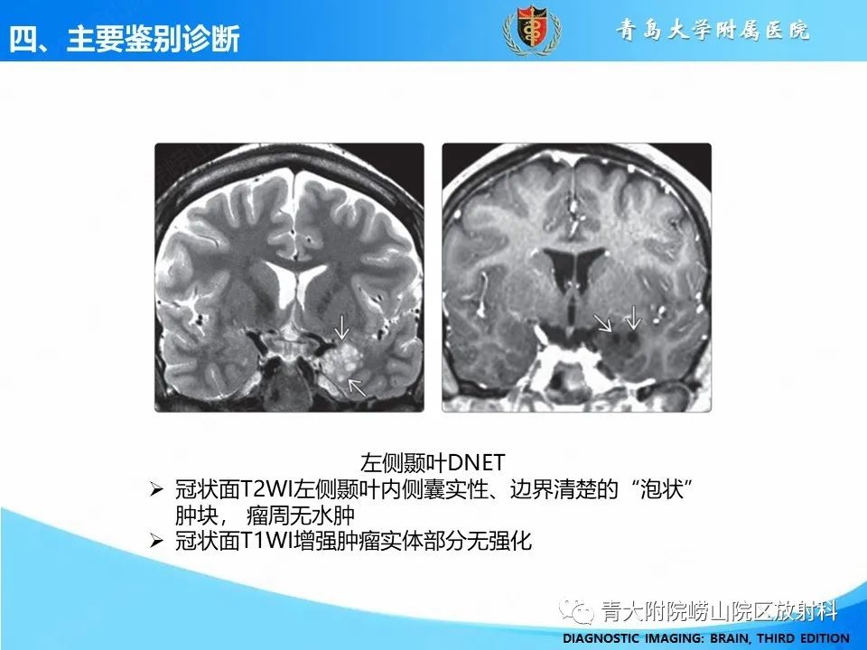 影像PPT - 【PPT】少突胶质细胞肿瘤的影像诊断与鉴别-20