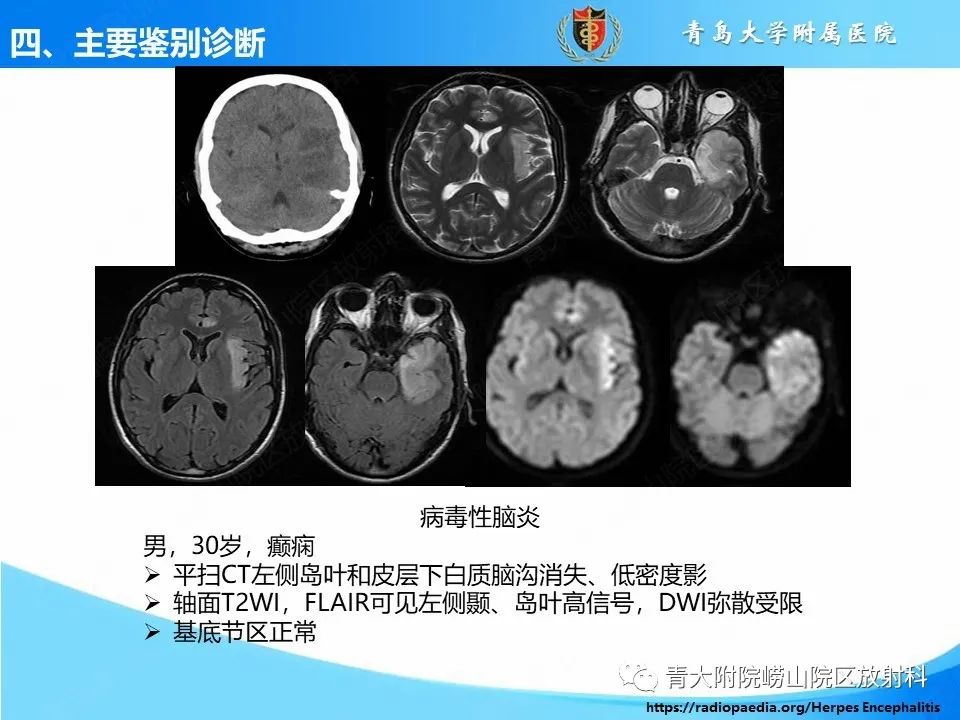 影像PPT - 【PPT】少突胶质细胞肿瘤的影像诊断与鉴别-25