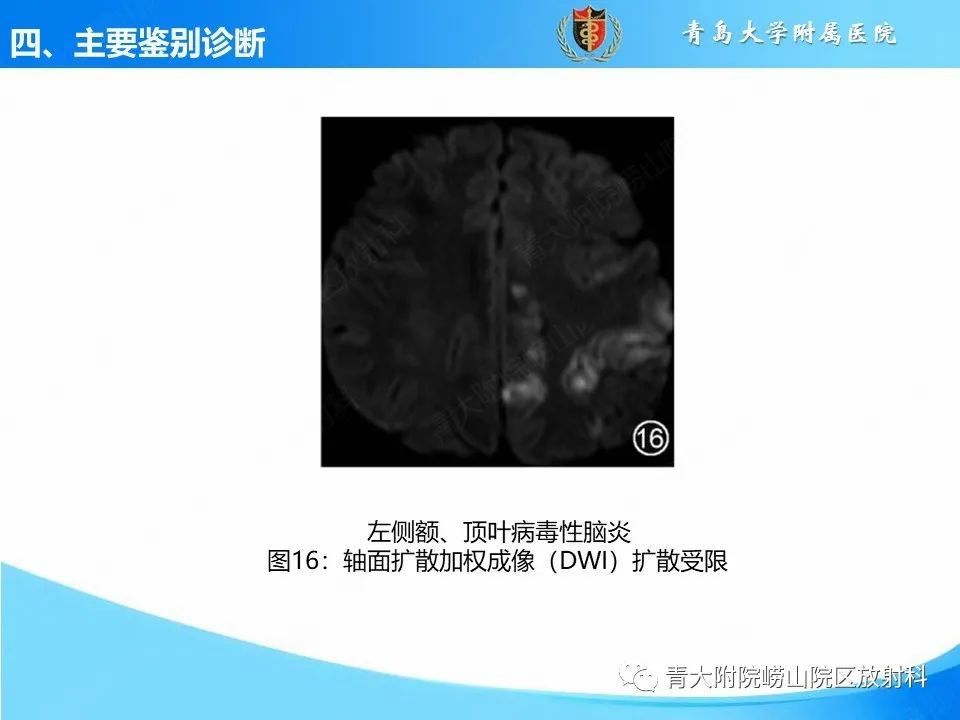 影像PPT - 【PPT】少突胶质细胞肿瘤的影像诊断与鉴别-26