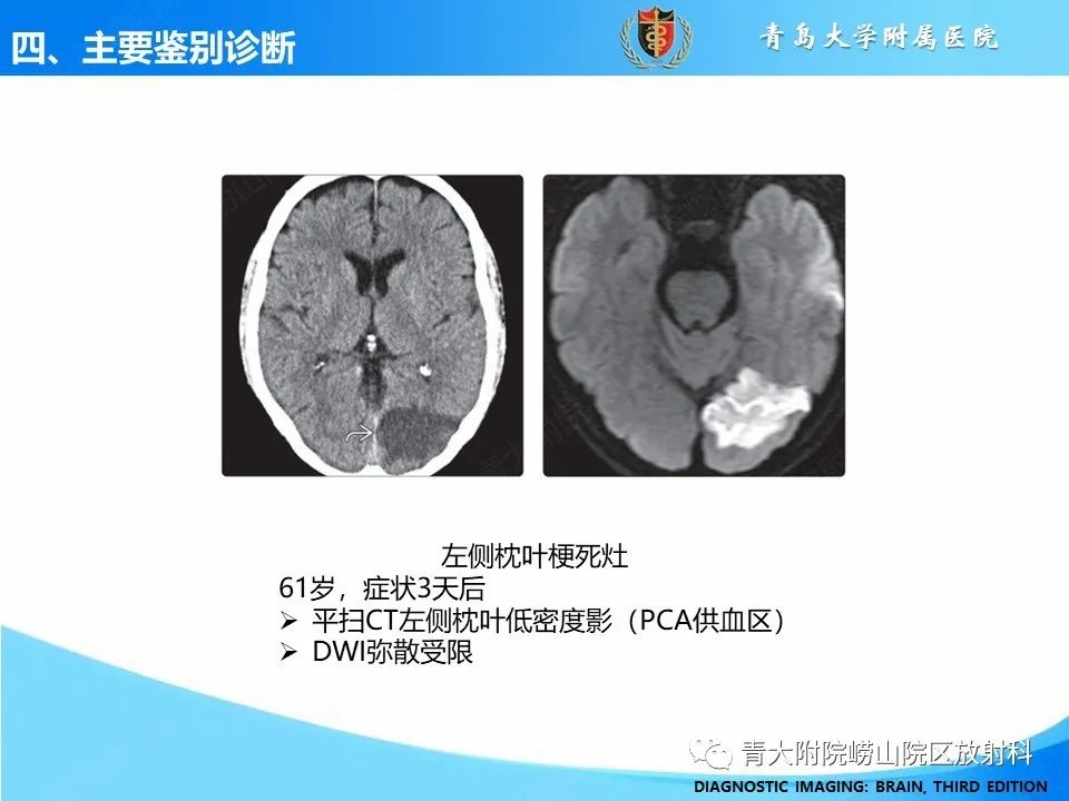 影像PPT - 【PPT】少突胶质细胞肿瘤的影像诊断与鉴别-29