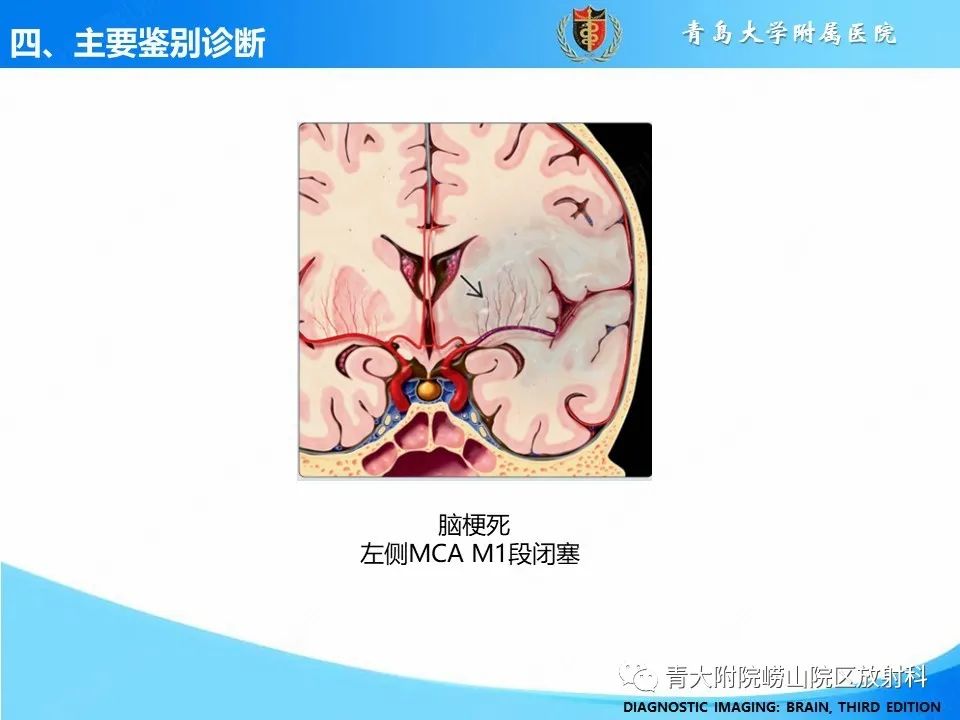 影像PPT - 【PPT】少突胶质细胞肿瘤的影像诊断与鉴别-28