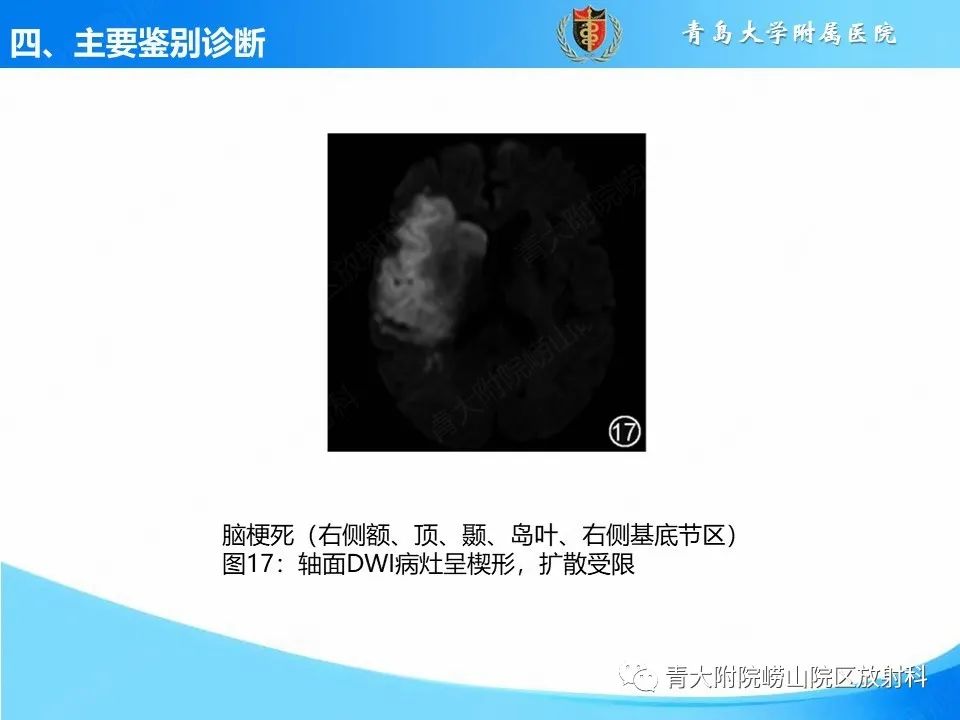 影像PPT - 【PPT】少突胶质细胞肿瘤的影像诊断与鉴别-30