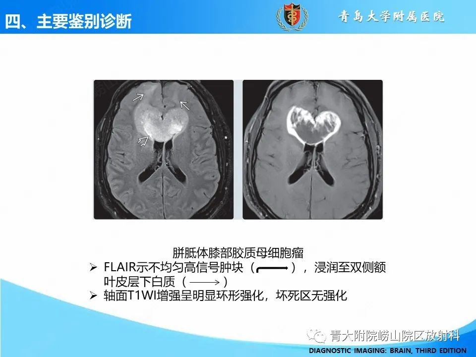 影像PPT - 【PPT】少突胶质细胞肿瘤的影像诊断与鉴别-34