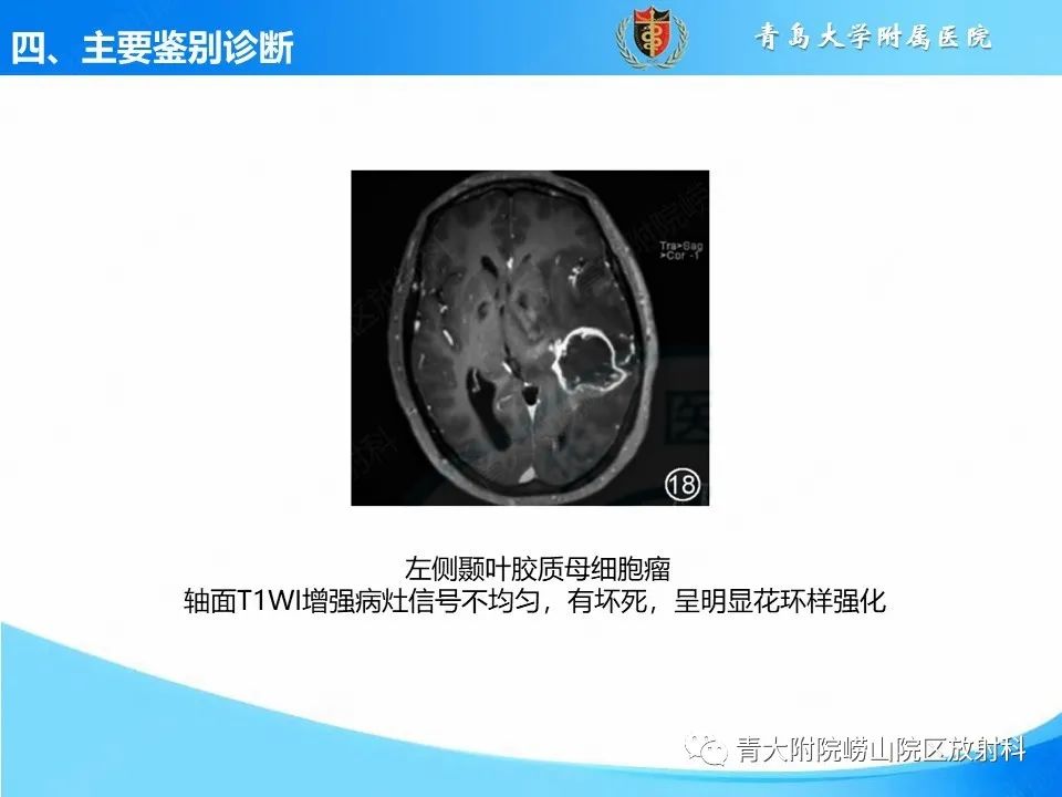 影像PPT - 【PPT】少突胶质细胞肿瘤的影像诊断与鉴别-35