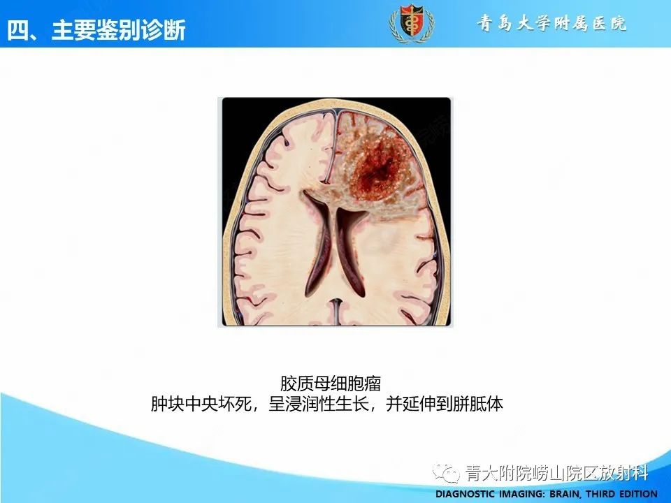 影像PPT - 【PPT】少突胶质细胞肿瘤的影像诊断与鉴别-32
