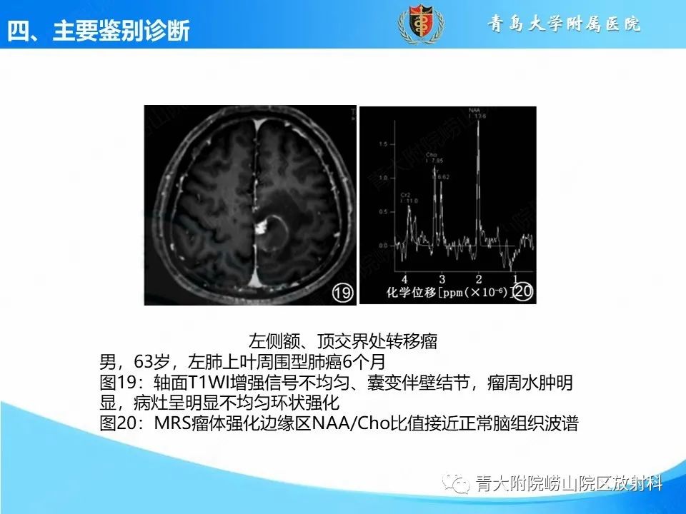 影像PPT - 【PPT】少突胶质细胞肿瘤的影像诊断与鉴别-37