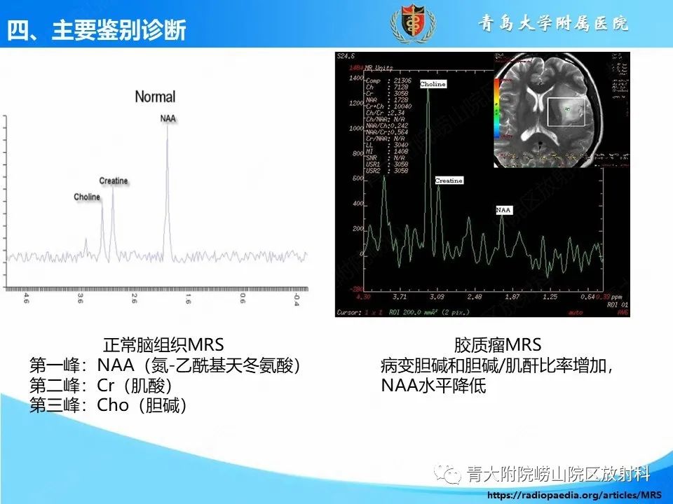 影像PPT - 【PPT】少突胶质细胞肿瘤的影像诊断与鉴别-38
