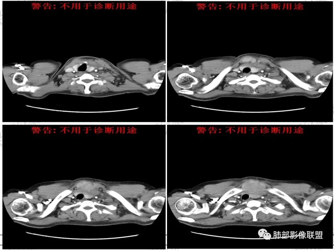 影像PPT - 【病例】 肉包骨,是骨淋巴瘤的特征吗?-10 影像PPT - 【病例】 肉包骨,是骨淋巴瘤的特征吗?-10
