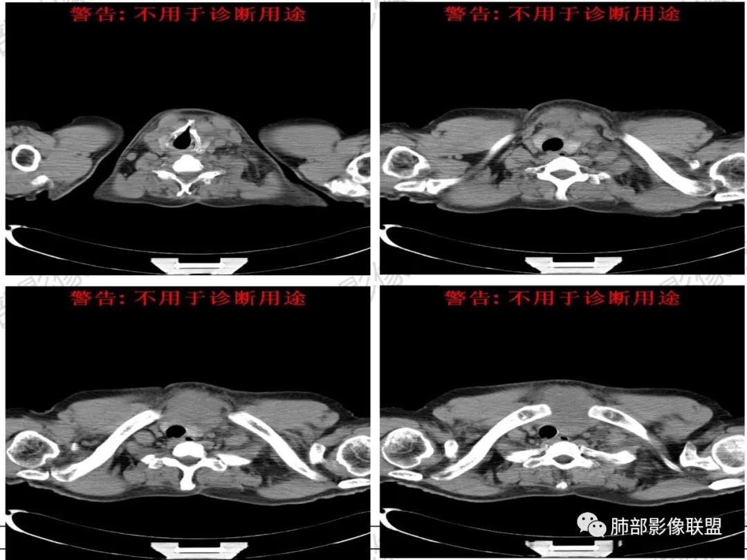影像PPT - 【病例】 肉包骨,是骨淋巴瘤的特征吗?-7 影像PPT - 【病例】 肉包骨,是骨淋巴瘤的特征吗?-7