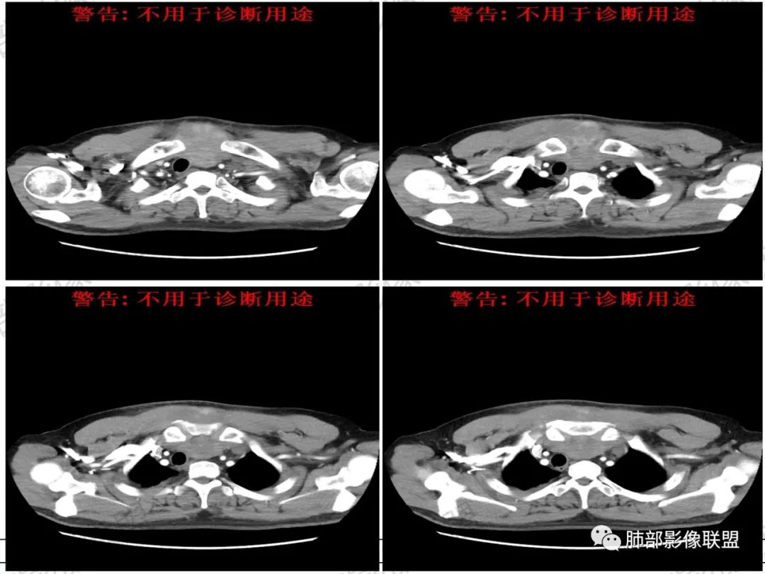 影像PPT - 【病例】 肉包骨,是骨淋巴瘤的特征吗?-11 影像PPT - 【病例】 肉包骨,是骨淋巴瘤的特征吗?-11