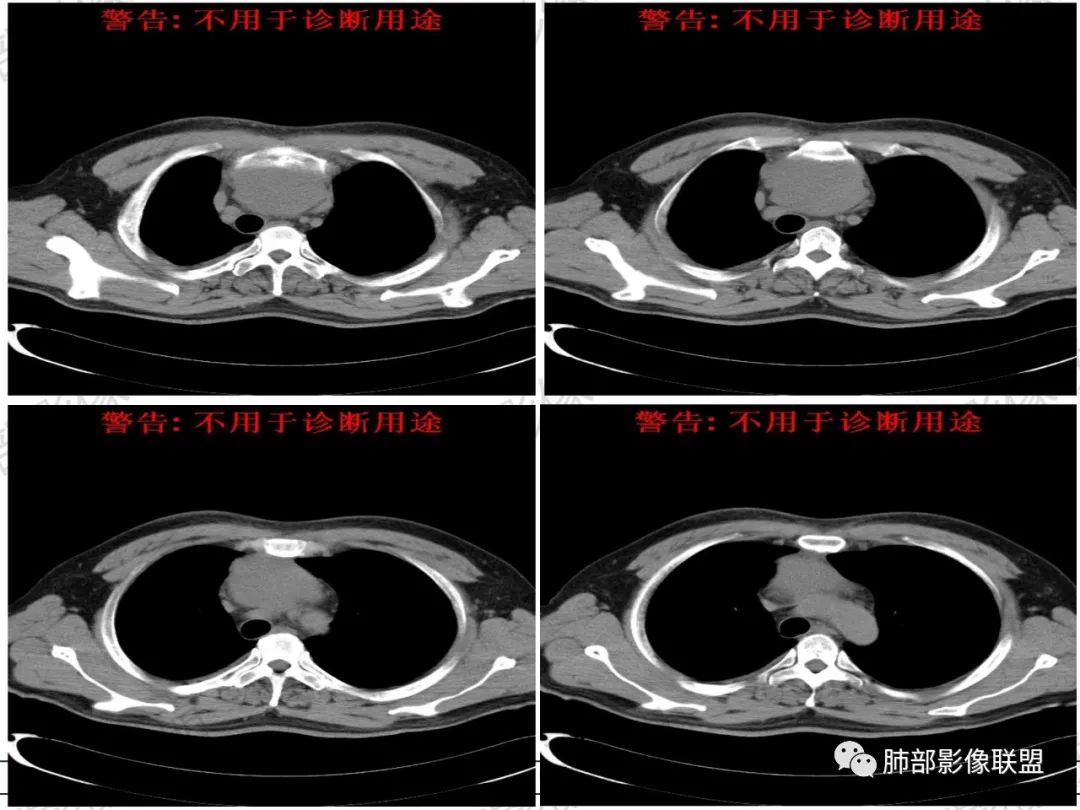 影像PPT - 【病例】 肉包骨,是骨淋巴瘤的特征吗?-9 影像PPT - 【病例】 肉包骨,是骨淋巴瘤的特征吗?-9