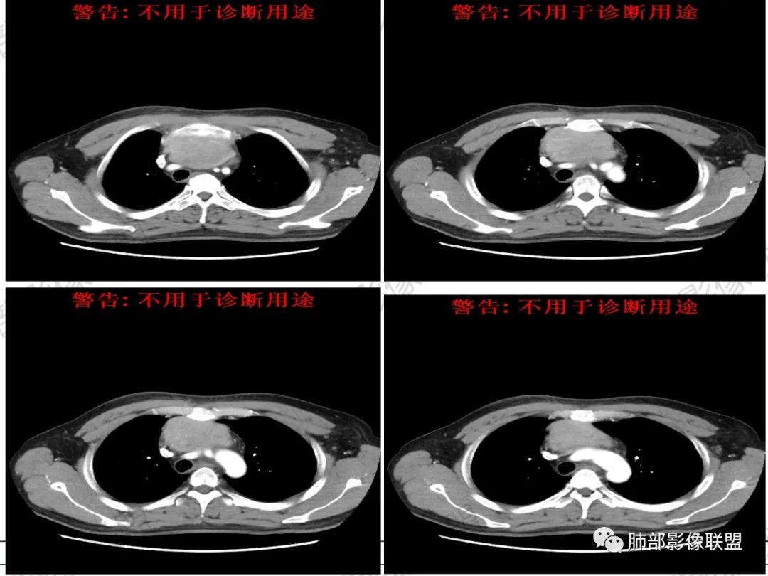 影像PPT - 【病例】 肉包骨,是骨淋巴瘤的特征吗?-12 影像PPT - 【病例】 肉包骨,是骨淋巴瘤的特征吗?-12