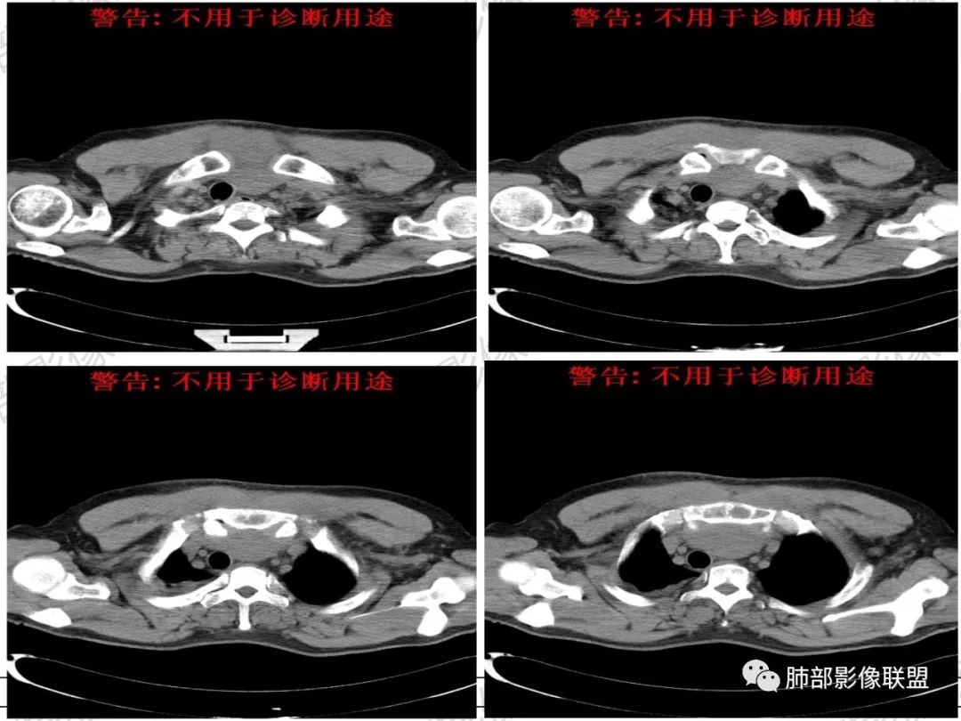 影像PPT - 【病例】 肉包骨,是骨淋巴瘤的特征吗?-8 影像PPT - 【病例】 肉包骨,是骨淋巴瘤的特征吗?-8
