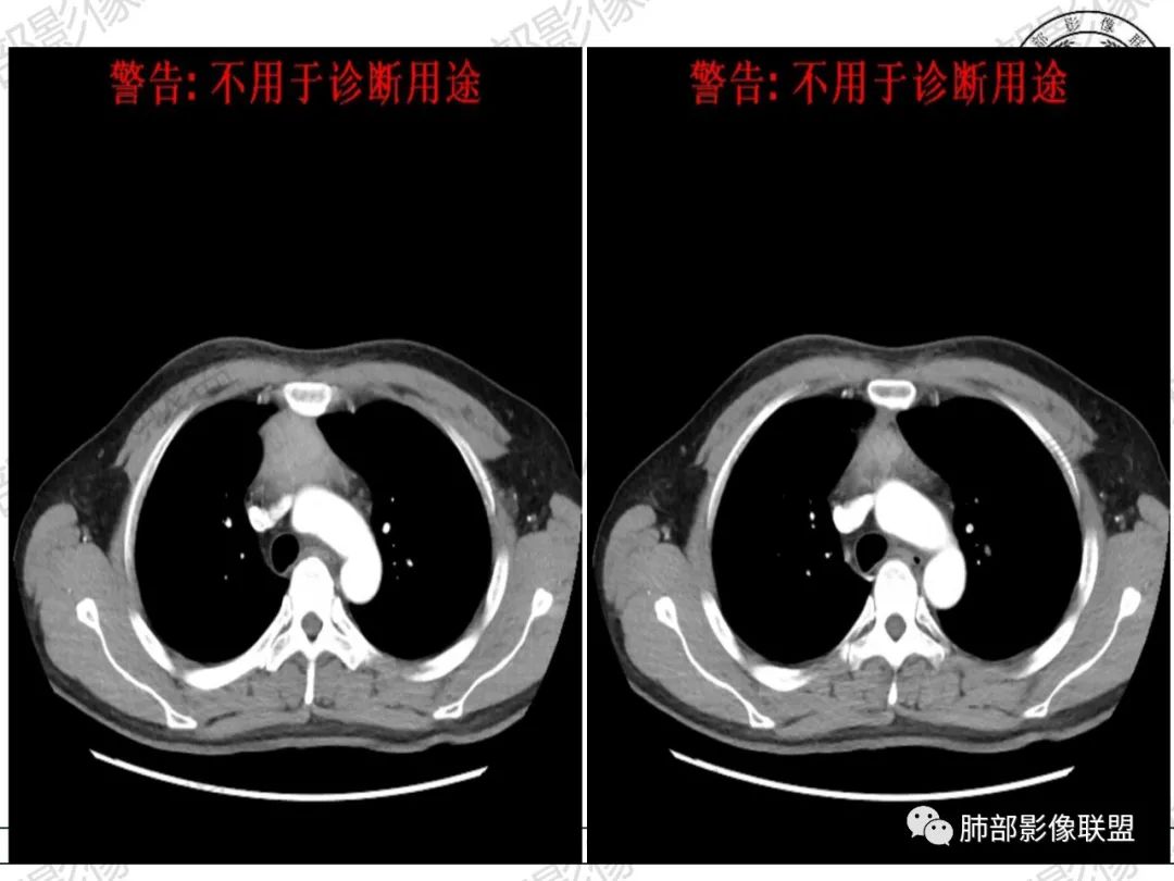 影像PPT - 【病例】 肉包骨,是骨淋巴瘤的特征吗?-13 影像PPT - 【病例】 肉包骨,是骨淋巴瘤的特征吗?-13
