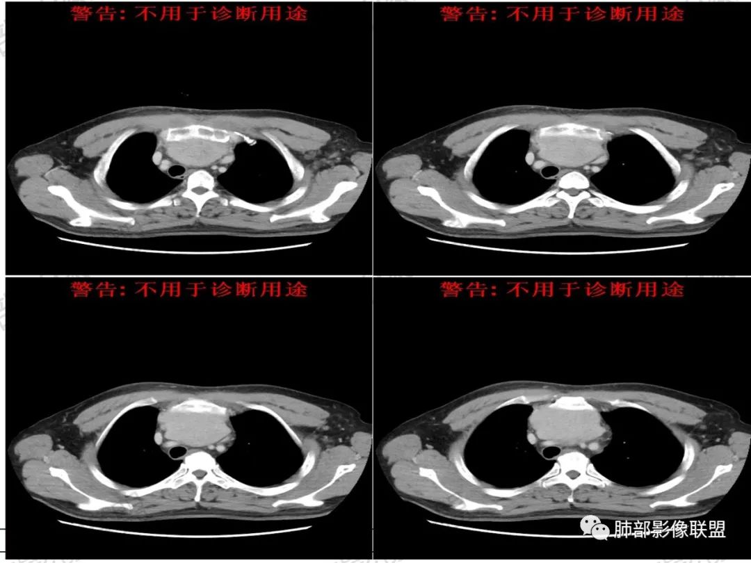 影像PPT - 【病例】 肉包骨,是骨淋巴瘤的特征吗?-17 影像PPT - 【病例】 肉包骨,是骨淋巴瘤的特征吗?-17