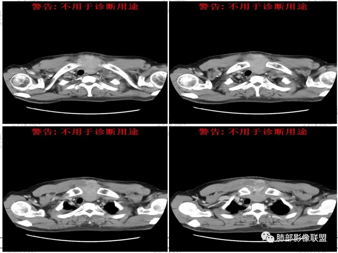 影像PPT - 【病例】 肉包骨,是骨淋巴瘤的特征吗?-15 影像PPT - 【病例】 肉包骨,是骨淋巴瘤的特征吗?-15