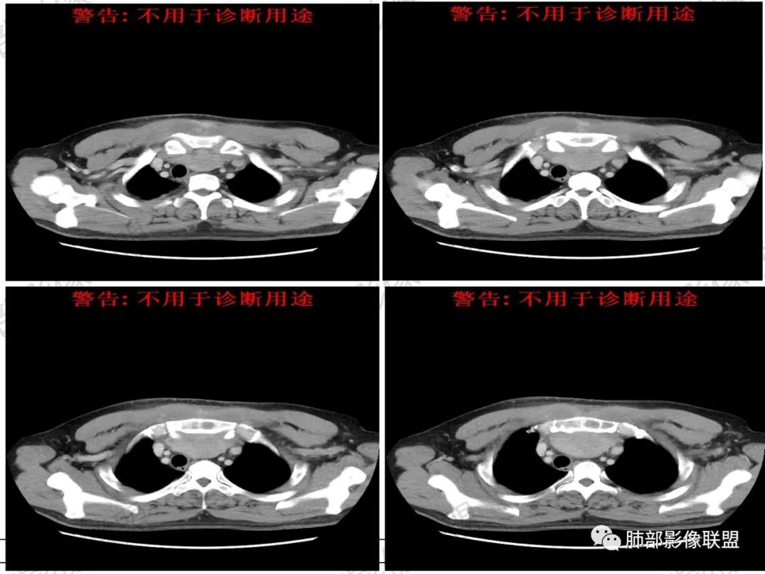 影像PPT - 【病例】 肉包骨,是骨淋巴瘤的特征吗?-16 影像PPT - 【病例】 肉包骨,是骨淋巴瘤的特征吗?-16