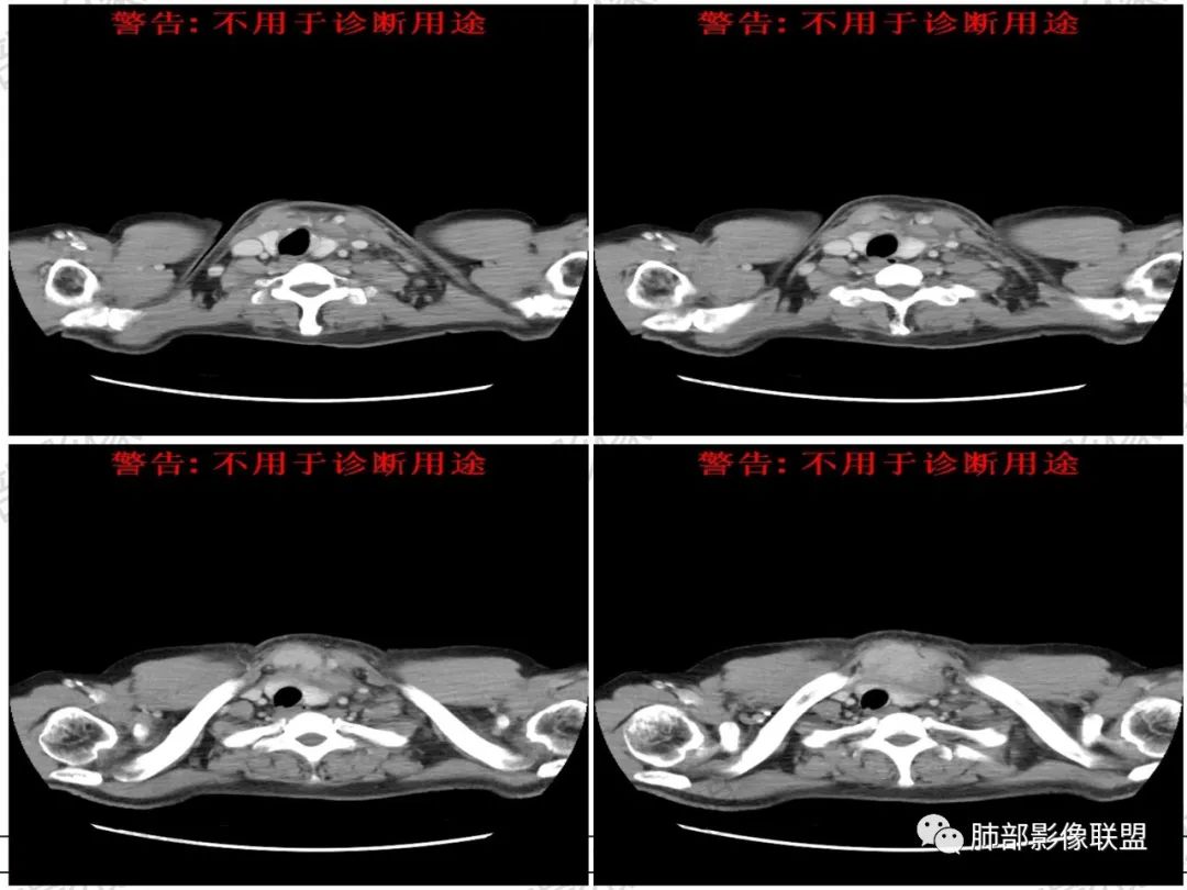 影像PPT - 【病例】 肉包骨,是骨淋巴瘤的特征吗?-14 影像PPT - 【病例】 肉包骨,是骨淋巴瘤的特征吗?-14