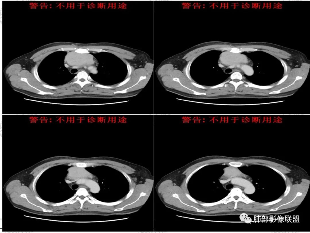 影像PPT - 【病例】 肉包骨,是骨淋巴瘤的特征吗?-18 影像PPT - 【病例】 肉包骨,是骨淋巴瘤的特征吗?-18