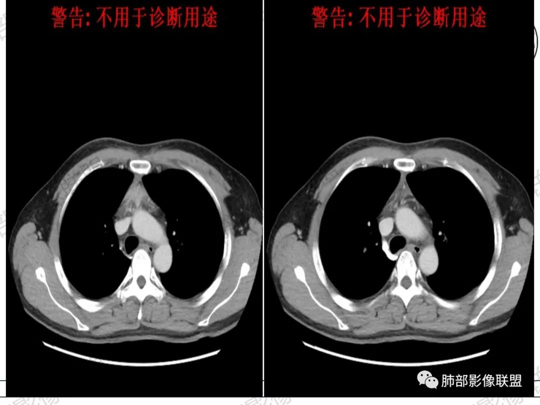 影像PPT - 【病例】 肉包骨,是骨淋巴瘤的特征吗?-19 影像PPT - 【病例】 肉包骨,是骨淋巴瘤的特征吗?-19