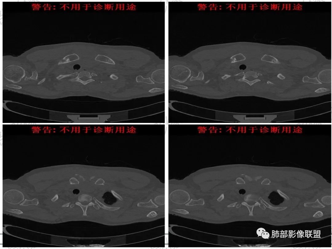 影像PPT - 【病例】 肉包骨,是骨淋巴瘤的特征吗?-31 影像PPT - 【病例】 肉包骨,是骨淋巴瘤的特征吗?-31