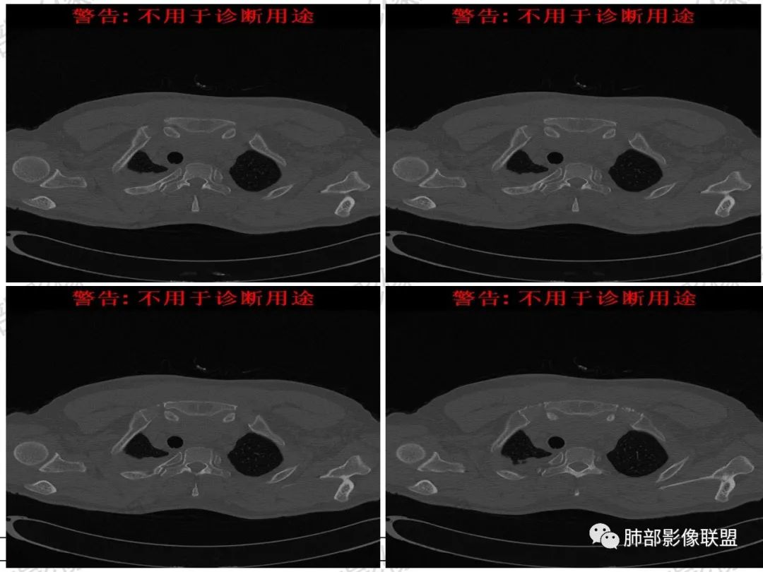 影像PPT - 【病例】 肉包骨,是骨淋巴瘤的特征吗?-33 影像PPT - 【病例】 肉包骨,是骨淋巴瘤的特征吗?-33
