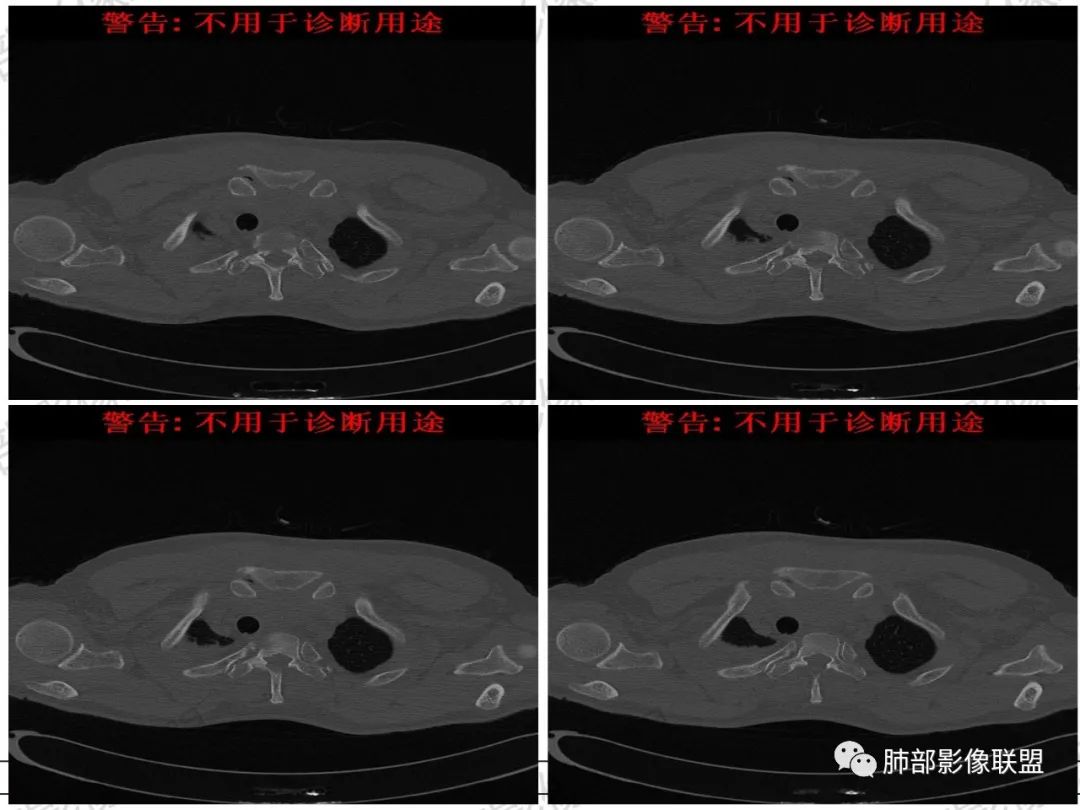 影像PPT - 【病例】 肉包骨,是骨淋巴瘤的特征吗?-32 影像PPT - 【病例】 肉包骨,是骨淋巴瘤的特征吗?-32